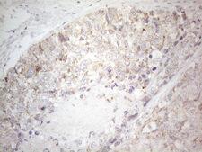 BTG2 Antibody - Immunohistochemical staining of paraffin-embedded Adenocarcinoma of Human endometrium tissue using anti-BTG2 mouse monoclonal antibody. (Heat-induced epitope retrieval by 1mM EDTA in 10mM Tris buffer. (pH8.5) at 120°C for 3 min. (1:150)