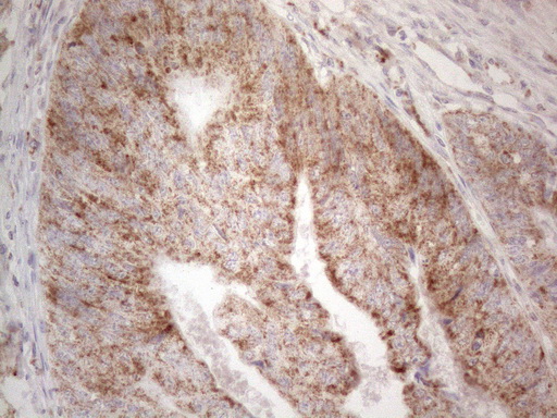 BTG2 Antibody - Immunohistochemical staining of paraffin-embedded Adenocarcinoma of Human colon tissue using anti-BTG2 mouse monoclonal antibody. (Heat-induced epitope retrieval by 1mM EDTA in 10mM Tris buffer. (pH8.5) at 120°C for 3 min. (1:150)