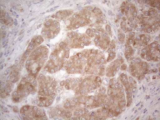 BTG2 Antibody - Immunohistochemical staining of paraffin-embedded Carcinoma of Human liver tissue using anti-BTG2 mouse monoclonal antibody. (Heat-induced epitope retrieval by 1mM EDTA in 10mM Tris buffer. (pH8.5) at 120°C for 3 min. (1:150)