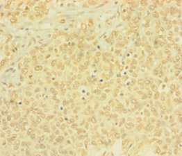 BTG4 Antibody - Immunohistochemistry of paraffin-embedded human ovarian cancer using BTG4 Antibody at dilution of 1: 100