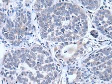 BTG4 Antibody - Immunohistochemistry of paraffin-embedded Human esophagus cancer tissue  using BTG4 Polyclonal Antibody at dilution of 1:55(×200)