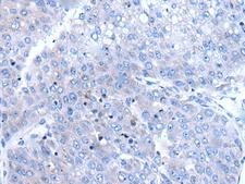 BTG4 Antibody - Immunohistochemistry of paraffin-embedded Human liver cancer tissue  using BTG4 Polyclonal Antibody at dilution of 1:65(×200)
