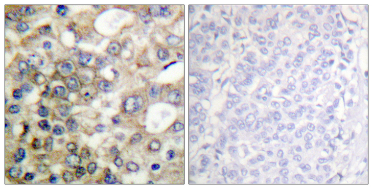 BTK Antibody - Immunohistochemistry analysis of paraffin-embedded human breast carcinoma tissue, using BTK Antibody. The picture on the right is blocked with the synthesized peptide.