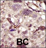 BTK Antibody - Formalin-fixed and paraffin-embedded human cancer tissue reacted with the primary antibody, which was peroxidase-conjugated to the secondary antibody, followed by DAB staining. This data demonstrates the use of this antibody for immunohistochemistry; clinical relevance has not been evaluated. BC = breast carcinoma; HC = hepatocarcinoma.