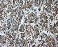 BTK Antibody - IHC of paraffin-embedded Carcinoma of liver tissue using anti-BTK mouse monoclonal antibody. (Dilution 1:50).
