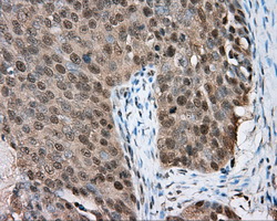 BTK Antibody - IHC of paraffin-embedded Adenocarcinoma of ovary tissue using anti-BTK mouse monoclonal antibody. (Dilution 1:50).