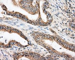 BTK Antibody - IHC of paraffin-embedded Adenocarcinoma of colon tissue using anti-BTK mouse monoclonal antibody. (Dilution 1:50).