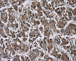 BTK Antibody - Immunohistochemical staining of paraffin-embedded Carcinoma of liver tissue using anti-BTK mouse monoclonal antibody. (Dilution 1:50).