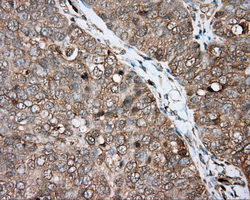 BTK Antibody - IHC of paraffin-embedded Adenocarcinoma of ovary tissue using anti-BTK mouse monoclonal antibody. (Dilution 1:50).