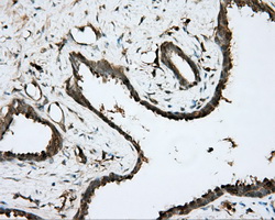 BTK Antibody - IHC of paraffin-embedded Carcinoma of prostate tissue using anti-BTK mouse monoclonal antibody. (Dilution 1:50).