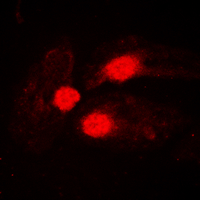 BTK Antibody - Immunofluorescent analysis of BTK (pY551) staining in Jurkat cells. Formalin-fixed cells were permeabilized with 0.1% Triton X-100 in TBS for 5-10 minutes and blocked with 3% BSA-PBS for 30 minutes at room temperature. Cells were probed with the primary antibody in 3% BSA-PBS and incubated overnight at 4 C in a humidified chamber. Cells were washed with PBST and incubated with a DyLight 594-conjugated secondary antibody (red) in PBS at room temperature in the dark. DAPI was used to stain the cell nuclei (blue).