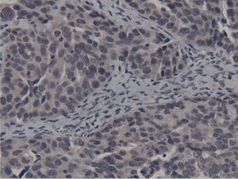 BTN1A1 Antibody - Immunohistochemical staining of paraffin-embedded Adenocarcinoma of Human ovary tissue using anti-BTN1A1 mouse monoclonal antibody.