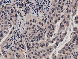 BTN1A1 Antibody - Immunohistochemical staining of paraffin-embedded Carcinoma of Human bladder tissue using anti-BTN1A1 mouse monoclonal antibody.