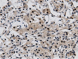 BTN1A1 Antibody - Immunohistochemical staining of paraffin-embedded Carcinoma of Human kidney tissue using anti-BTN1A1 mouse monoclonal antibody.