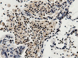 BTN1A1 Antibody - Immunohistochemical staining of paraffin-embedded Carcinoma of Human lung tissue using anti-BTN1A1 mouse monoclonal antibody.