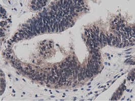 BTN1A1 Antibody - Immunohistochemical staining of paraffin-embedded Adenocarcinoma of Human endometrium tissue using anti-BTN1A1 mouse monoclonal antibody.