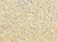 BTN1A1 Antibody - Immunohistochemistry of paraffin-embedded human liver cancer at dilution 1:100