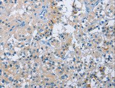 BTN2A2 Antibody - Immunohistochemistry of paraffin-embedded Human thyroid cancer using BTN2A2 Polyclonal Antibody at dilution of 1:50.