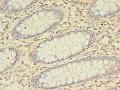 BTN3A1 / CD277 Antibody - Immunohistochemistry of paraffin-embedded human colon cancer using BTN3A1 Antibody at dilution of 1:100