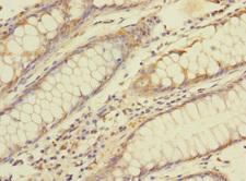 BTNL3 Antibody - Immunohistochemistry of paraffin-embedded human colon cancer using BTNL3 Antibody at dilution of 1:100