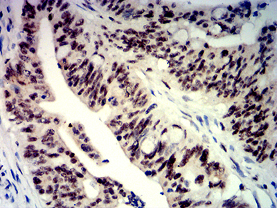 BTRCP / BETA-TRCP Antibody - Immunohistochemical analysis of paraffin-embedded rectum cancer tissues using BTRC mouse mAb with DAB staining.