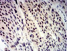 BTRCP / BETA-TRCP Antibody - Immunohistochemical analysis of paraffin-embedded rectum cancer tissues using BTRC mouse mAb with DAB staining.