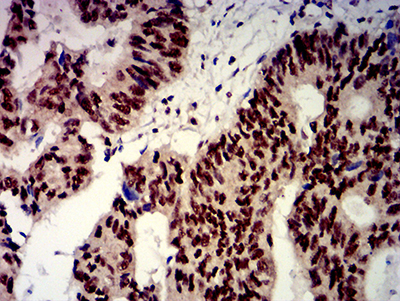 BTRCP / BETA-TRCP Antibody - Immunohistochemical analysis of paraffin-embedded esophageal cancer tissues using BTRC mouse mAb with DAB staining.