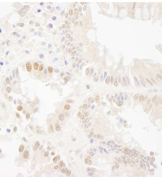 BUB1 Antibody - Detection of Human Bub1 by Immunohistochemistry. Sample: FFPE section of human colon carcinoma. Antibody: Affinity purified rabbit anti-Bub1 used at a dilution of 1:1000 (1 ug/ml).