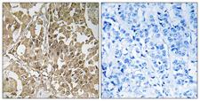 BUB1 Antibody - Immunohistochemistry analysis of paraffin-embedded human breast carcinoma tissue, using BUB1 Antibody. The picture on the right is blocked with the synthesized peptide.