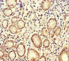 BUB1 Antibody - Immunohistochemistry of paraffin-embedded human gastric cancer at dilution of 1:100