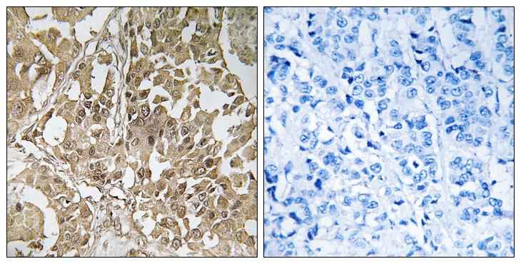 BUB1 Antibody - Peptide - + Immunohistochemistry analysis of paraffin-embedded human breast carcinoma tissue, using BUB1 antibody.