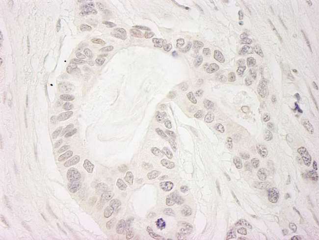 BUB1B / BubR1 Antibody - Detection of Human BubR1 by Immunohistochemistry. Sample: FFPE section of human ovarian carcinoma. Antibody: Affinity purified rabbit anti-BubR1 used at a dilution of 1:200 (1 ug/ml).