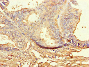 BUB1B / BubR1 Antibody - Immunohistochemistry of paraffin-embedded human endometrial cancer at dilution of 1:100