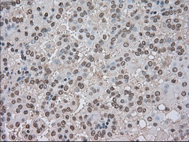 BUB1B / BubR1 Antibody - IHC of paraffin-embedded Carcinoma of kidney tissue using anti-BUB1B mouse monoclonal antibody. (Dilution 1:50).
