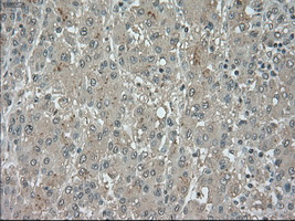 BUB1B / BubR1 Antibody - IHC of paraffin-embedded Carcinoma of liver tissue using anti-BUB1B mouse monoclonal antibody. (Dilution 1:50).