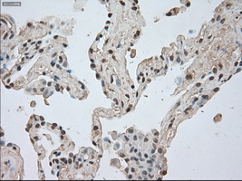 BUB1B / BubR1 Antibody - IHC of paraffin-embedded Carcinoma of lung tissue using anti-BUB1B mouse monoclonal antibody. (Dilution 1:50).
