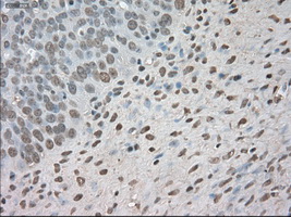 BUB1B / BubR1 Antibody - IHC of paraffin-embedded Adenocarcinoma of ovary tissue using anti-BUB1B mouse monoclonal antibody. (Dilution 1:50).