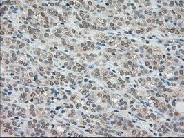 BUB1B / BubR1 Antibody - IHC of paraffin-embedded Carcinoma of thyroid tissue using anti-BUB1B mouse monoclonal antibody. (Dilution 1:50).