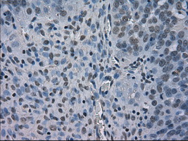 BUB1B / BubR1 Antibody - IHC of paraffin-embedded Adenocarcinoma of ovary tissue using anti-BUB1B mouse monoclonal antibody. (Dilution 1:50).