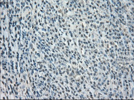 BUB1B / BubR1 Antibody - IHC of paraffin-embedded lymphoma tissue using anti-BUB1B mouse monoclonal antibody. (Dilution 1:50).