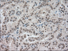 BUB1B / BubR1 Antibody - IHC of paraffin-embedded Carcinoma of kidney tissue using anti-BUB1B mouse monoclonal antibody. (Dilution 1:50).
