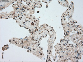 BUB1B / BubR1 Antibody - IHC of paraffin-embedded Carcinoma of lung tissue using anti-BUB1B mouse monoclonal antibody. (Dilution 1:50).