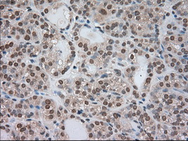 BUB1B / BubR1 Antibody - IHC of paraffin-embedded Carcinoma of thyroid tissue using anti-BUB1B mouse monoclonal antibody. (Dilution 1:50).