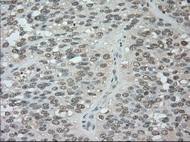 BUB1B / BubR1 Antibody - IHC of paraffin-embedded Carcinoma of bladder tissue using anti-BUB1B mouse monoclonal antibody. (Dilution 1:50).