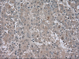 BUB1B / BubR1 Antibody - IHC of paraffin-embedded Carcinoma of liver tissue using anti-BUB1B mouse monoclonal antibody. (Dilution 1:50).