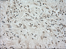 BUB1B / BubR1 Antibody - IHC of paraffin-embedded Carcinoma of pancreas tissue using anti-BUB1B mouse monoclonal antibody. (Dilution 1:50).