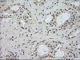 BUB1B / BubR1 Antibody - IHC of paraffin-embedded Carcinoma of prostate tissue using anti-BUB1B mouse monoclonal antibody. (Dilution 1:50).