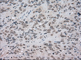 BUB1B / BubR1 Antibody - IHC of paraffin-embedded Carcinoma of bladder tissue using anti-BUB1B mouse monoclonal antibody. (Dilution 1:50).