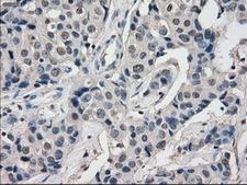 BUB1B / BubR1 Antibody - IHC of paraffin-embedded Adenocarcinoma of breast tissue using anti-BUB1B mouse monoclonal antibody. (Dilution 1:50).