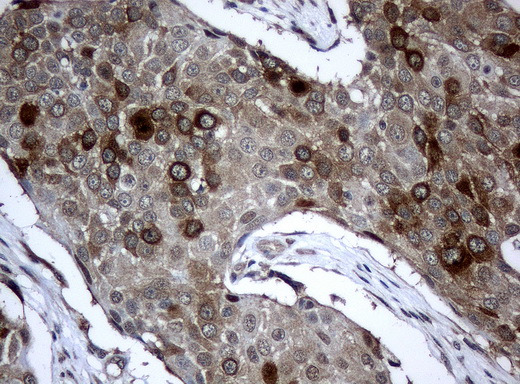 BUB1B / BubR1 Antibody - Immunohistochemical staining of paraffin-embedded Carcinoma of lung tissue using anti-BUB1Bmouse monoclonal antibody. (Clone UMAB7, dilution 1:100; heat-induced epitope retrieval by 10mM citric buffer, pH6.0, 120C for 3min)